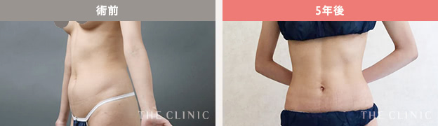 術前 / 5年後