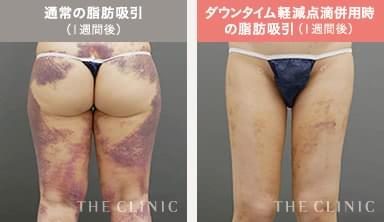 通常の脂肪吸引(1週間後) / ダウンタイム軽減点滴併用時の脂肪吸引(1週間後)