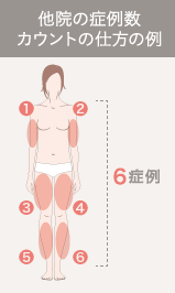 他院の症例数カウントの仕方の例