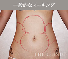 中にはマーキングを行わないクリニックも