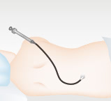 他院の麻酔(硬膜外麻酔)