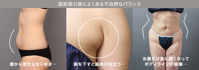 脂肪吸引後によくある不自然なバランス