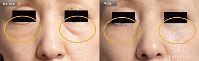 目の下のクマ改善のためのマイクロCRF注入(顔の脂肪注入)の症例