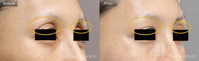 目の上のくぼみ改善のためのマイクロCRF注入(顔の脂肪注入)の症例