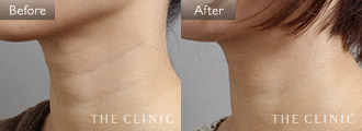 首のシワ改善のためのマイクロCRF注入(顔の脂肪注入)の症例