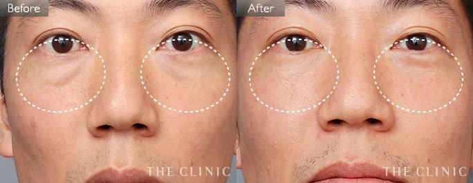 目の下のたるみ改善(志田ドクター)