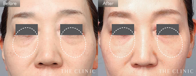 目の下のたるみ改善(女性/50歳)の症例