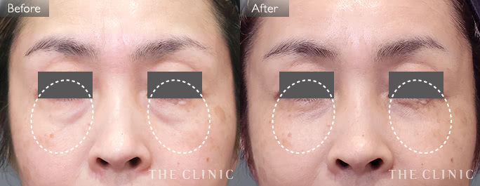 目の下のクマ・たるみ改善(女性/51歳)の症例