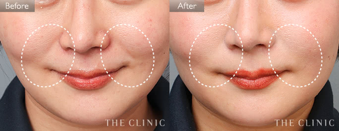 ほうれい線・口横のたるみ改善(女性/33歳)の症例