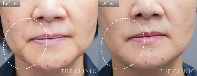 頬のたるみ改善(女性/51歳)の症例