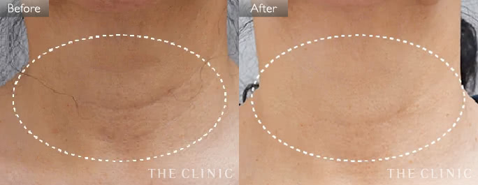 首のシワ改善(女性/64歳)の症例