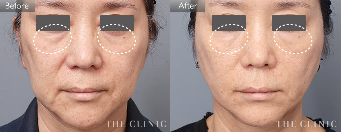 目の下のたるみ・顔全体のトータル改善（女性／58歳）の症例