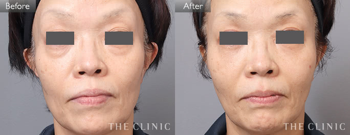 目の下のたるみ改善（女性／59歳）の症例