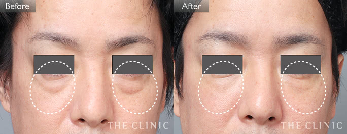 目の下のクマ・たるみ改善（男性／42歳）の症例