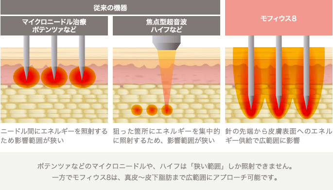 ポテンツァなどのマイクロニードルや、ハイフは「狭い範囲」しか照射できません。 一方でモフィウス8は、真皮〜皮下脂肪まで広範囲にアプローチ可能です。