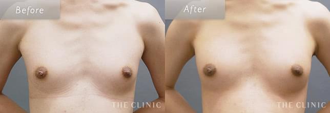 脂肪注入豊胸でバストアップ 29歳男性のMTF症例写真