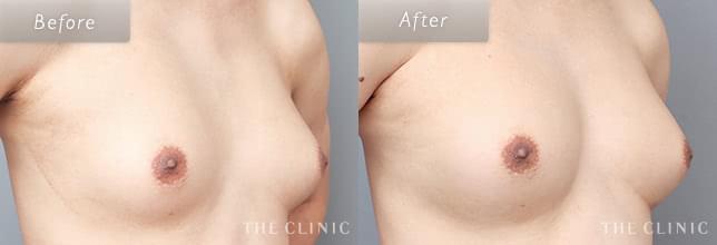 脂肪注入豊胸でバストアップ 40歳男性のMTF症例写真