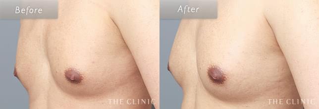 「BEbra(ビブラ)」を併用した脂肪注入豊胸でバストアップ 25歳男性のMTF症例写真