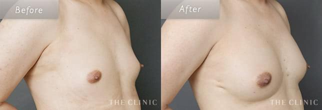 上向きバスト豊胸でバストアップ 48歳男性のMTF症例写真