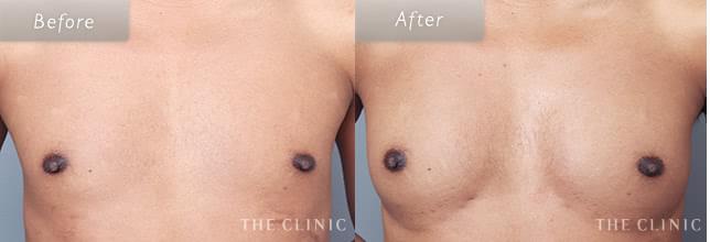 上向きバスト豊胸でバストアップ 28歳男性のMTF症例写真