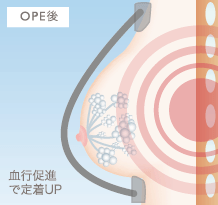 乳房拡張機器・ビブラの仕組み オペ後