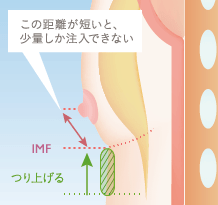 上向きバスト豊胸の施術方法の一例 下乳にスペースを作る