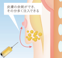 上向きバスト豊胸の施術方法の一例 下乳のスペースに脂肪注入