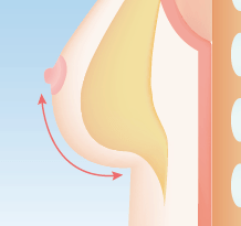 上向きバスト豊胸の施術方法の一例 下乳にボリュームのある上向きバスト