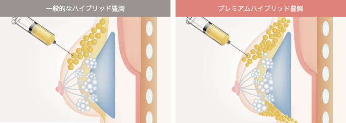 ハイブリッド豊胸とプレミアムハイブリッド豊胸の違い