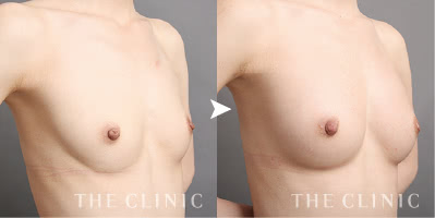 痩せ型でも形のキレイなボリュームバストに（27歳）施術前後の比較