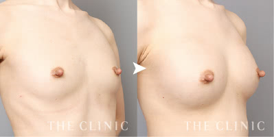 デコルテ～下乳までバランス良くふっくら（26歳）施術前後の比較