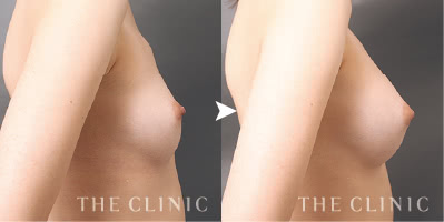 横から見ても自然で高さのある立体バスト（20歳）施術前後の比較