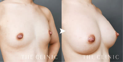 ３度の注入で憧れのボリュームバストに（29歳）施術前後の比較