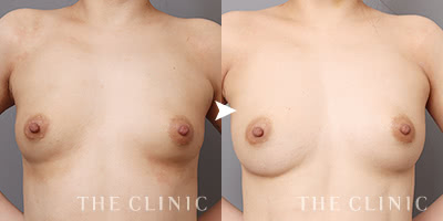 ボリュームのバランスや離れ乳も改善（30歳）施術前後の比較