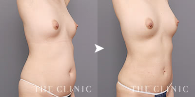 バストアップと同時にお腹もスッキリ（42歳）施術前後の比較