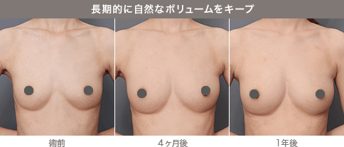 長期的に自然なボリュームをキープ