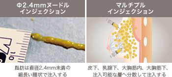 2.4mmヌードルインジェクションとマルチプルインジェクションの注入方法の比較図