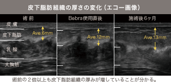 乳房拡張器Bebra使用前後の皮下脂肪組織の厚さの変化（エコー画像）