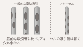 カニューレの違い