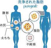 洗浄された脂肪 puregraft