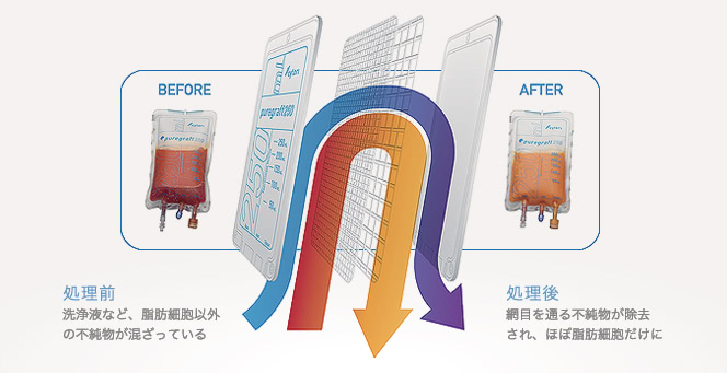クリーンな脂肪を注入 処理前:洗浄液など、脂肪細胞以外の不純物が混ざっている 処理後:網目を通る不純物が除去され、ほぼ脂肪細胞だけに