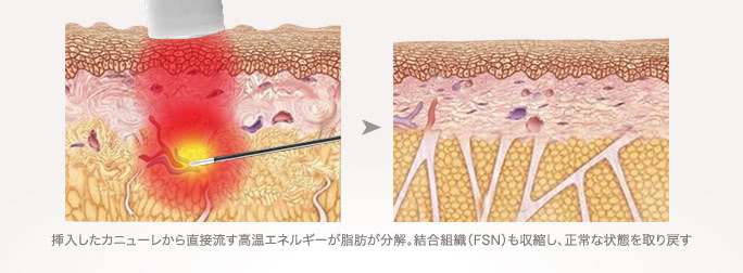 挿入したカニューレから直接流す高温エネルギーが脂肪が分解。結合組織（FSN）も収縮し、正常な状態を取り戻す