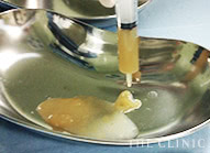 除去したアクアフィリング