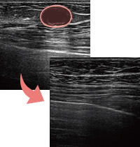 術後のエコー確認で安心を提供