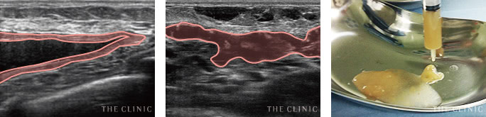 アクアフィリング豊胸のリスク