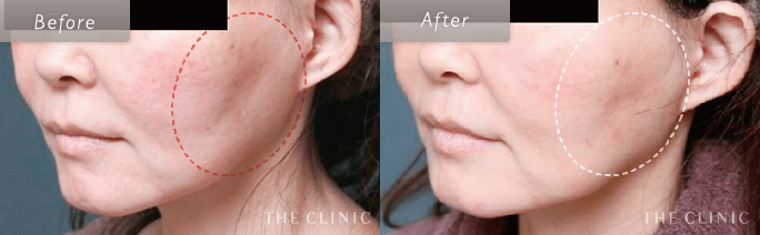 顔(頰・顎)の脂肪吸引の失敗修正の術前・術後の症例写真