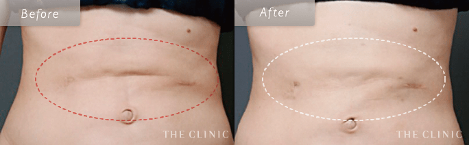 お腹の脂肪吸引の失敗修正の術前・術後の症例写真
