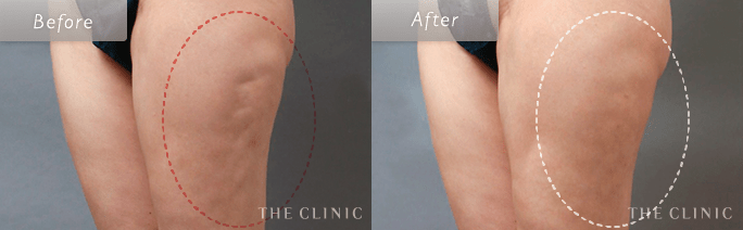 太ももの脂肪吸引の失敗(取りムラ)修正の術前・術後の症例写真