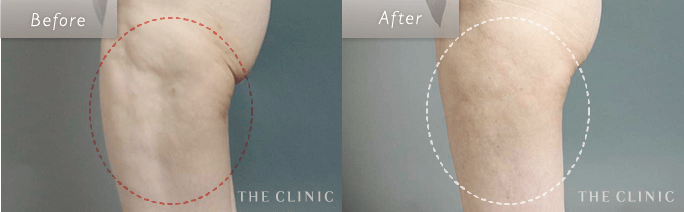 太ももの脂肪吸引の失敗(凸凹)修正の術前・術後の症例写真