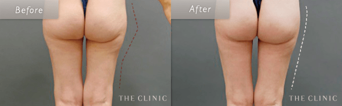 太もも/お尻の失敗修正の術前・術後の症例写真